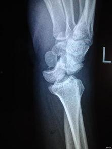 成人手腕脱臼手术视频