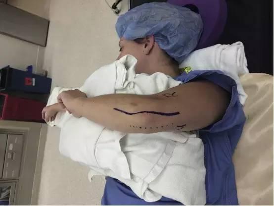 成人手腕脱臼手术视频 第2张 成人手腕脱臼手术视频 第2张