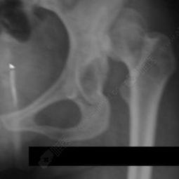 成人手腕脱臼手术视频 第3张 成人手腕脱臼手术视频 第3张