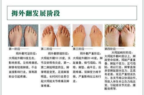 成人拐脚矫正方法视频,跟随视频教程，重拾稳健步伐  第3张